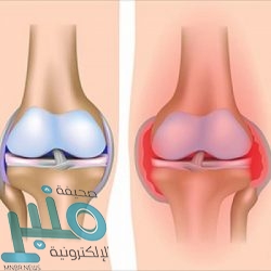 انقسام عالمي حول استخدام «هيدروكسي كلوروكين» لمعالجة المصابين بـ«كورونا»