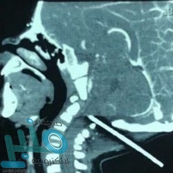 علاجات منزلية فعالة لتجنب الآثار السلبية لمرضى الكلى والمسالك البولية