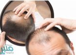 حل جديد لمشكلة «الصلع» بديلاً عن عمليات زرع الشعر