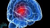 دراسة صادمة تحدد سبب الإصابة بسرطان المخ