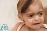مرض مفاجئ يصيب “طفلة” ويحوّل حياتها إلى مأساة