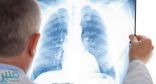 علماء صينيون يتوصلون لـ”علاج محتمل” لسرطان الرئة