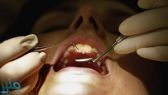 أبحاث تكشف ما يفعله إهمال صحة الفم بدماغ الإنسان