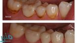 البقع البنية على الأسنان.. هل من طريقة للتخلص منها؟