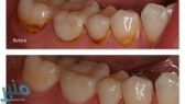 البقع البنية على الأسنان.. هل من طريقة للتخلص منها؟