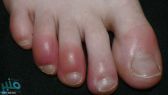 تغير أظافر القدمين دليل على “القاتل الصامت”