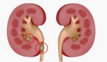 علامات أولية لتكون حصى الكلى .. تعرف عليها قبل فوات الأوان