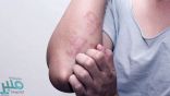 5 علاجات منزلية للتغلب على فطريات الجلد
