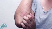 5 علاجات منزلية للتغلب على فطريات الجلد