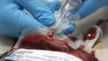 ”دم الشباب“.. دواء جديد يثبت فعاليته في علاج الزهايمر