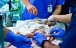 الفريق الطبي يبدأ عملية فصل التوأم الطفيلي اليمني في الرياض