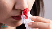 تعرف على أسباب نزيف الأنف الصيفي.. وكيفية تجنبه