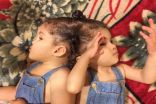 رسميًا.. تعذر فصل التوءم السيامي المصري “مي ومنة” ووالدهما: أشكر المملكة