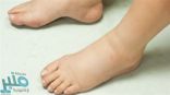اليك.. أسباب وطرق علاج تورّم القدمين