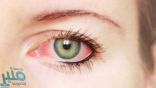 تعرف على… علاج التهاب فيروس العين والوقاية منه