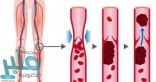 5 أشياء تجعلك عرضة لخطر الإصابة بالجلطات الدموية