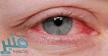 اعراض التهاب العين منها الاحمرار والزغللة