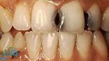 كيف يساعد التشخيص المبكر لتسوس الأسنان فى حمايتك من خلعها؟