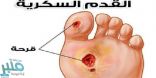 اليك.. مجموعة نصائح للوقاية من قرحة القدم السكرية