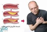 أحدث الطرق لعلاج الذبحة الصدرية!