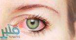 اليك… أسباب نزيف العين وطرق العلاج