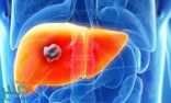 مرض تليّف الكبد… هذه أعراضه وطرق العلاج