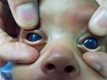 بيشة.. جراحة ناجحة لإزالة “مياه زرقاء” من عين طفل عمره شهر