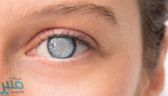 تعرف على أعراض “الجلوكوما”.. وطرق الوقاية منها
