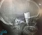 نصف سكين مغروس في وجه شاب بالطائف .. ماذا فعل الأطباء؟