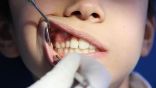 منظمة الصحة: أمراض الفم تصيب ما يقرب من نصف البشر