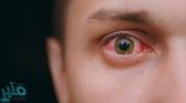 أعراض في العين تظهر ارتفاع مستويات الكوليسترول في الدم بشكل خطير