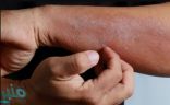 دراسة حديثة تكشف أعراض جلدية مرتبطة بكورونا