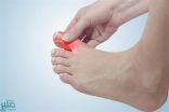 علامة في أصابع القدم تدل على ارتفاع الكوليسترول