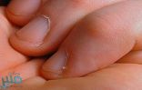تحذير طبي من قضم نتوءات الأظافر بالأسنان
