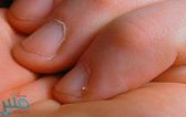 تحذير طبي من قضم نتوءات الأظافر بالأسنان